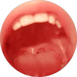 palatal snoring