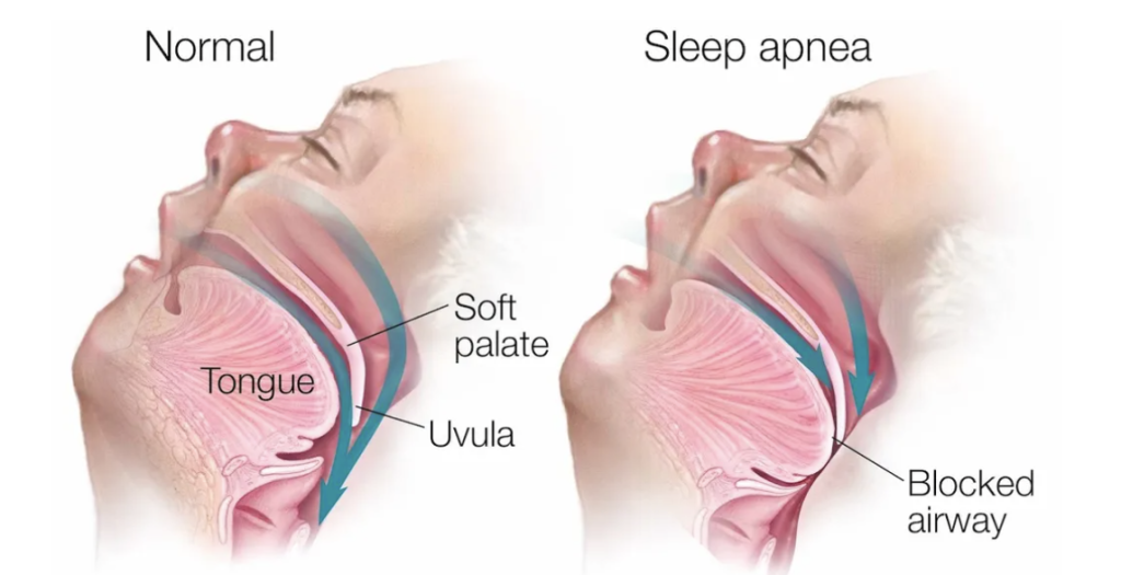 sleep apnea drawing