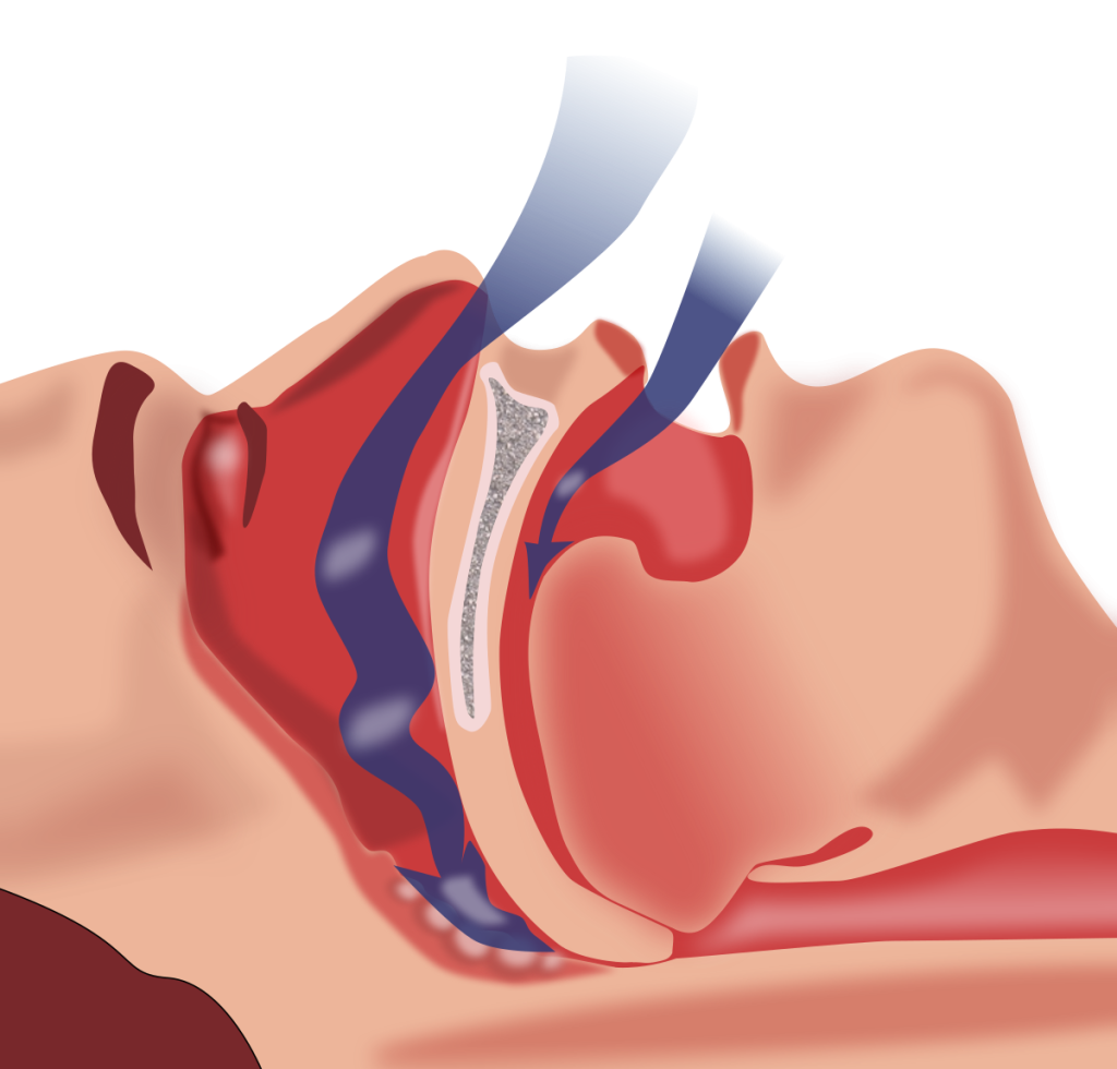 sleep apnea causes
