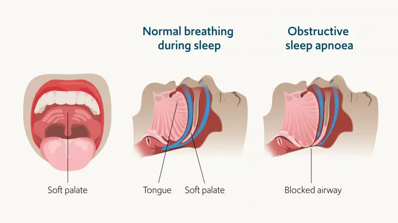 obstructive sleep apnea causes
